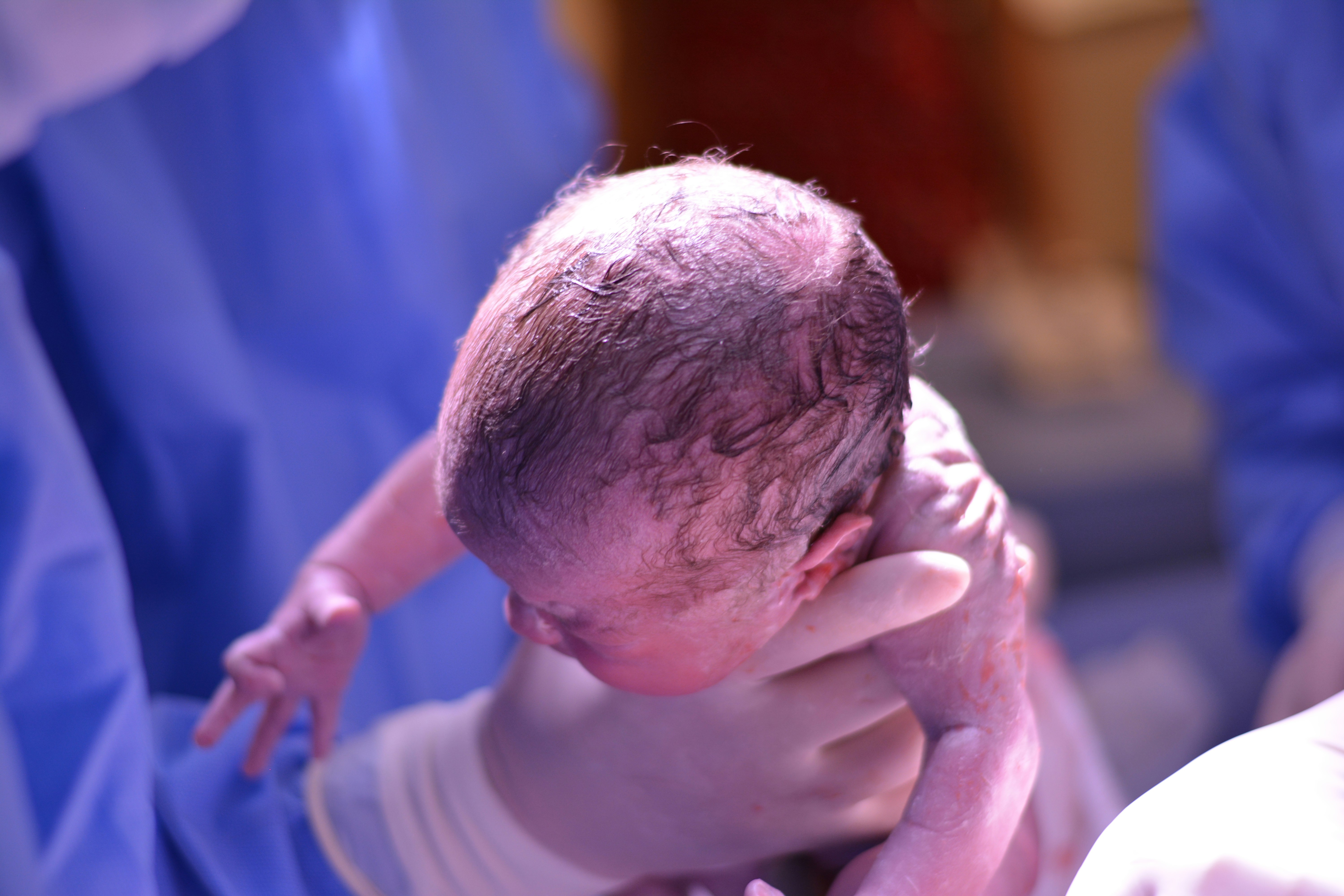 Caesarean Section Procedure